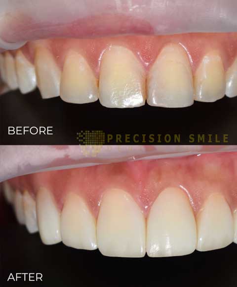 Achieve Your Dream Smile with Veneers