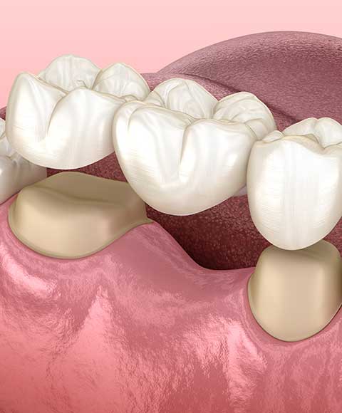 Crown and Fixed Bridge