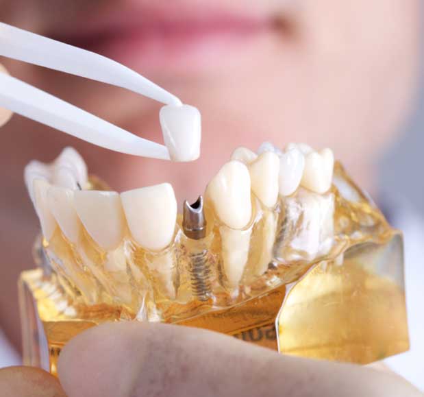 Dental Implants