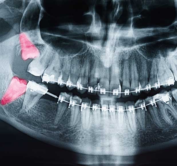 Dental X-Ray