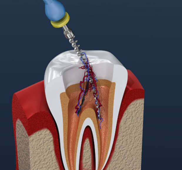 Endodontics