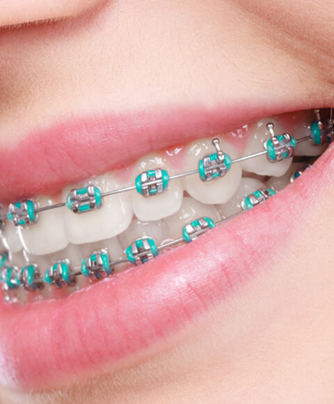 Is Braces right for you?