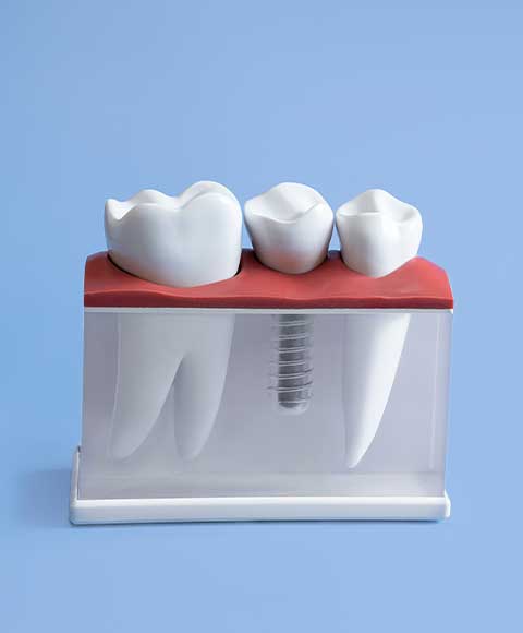 Is it worth saving your tooth? Root canal treatment or tooth extraction?