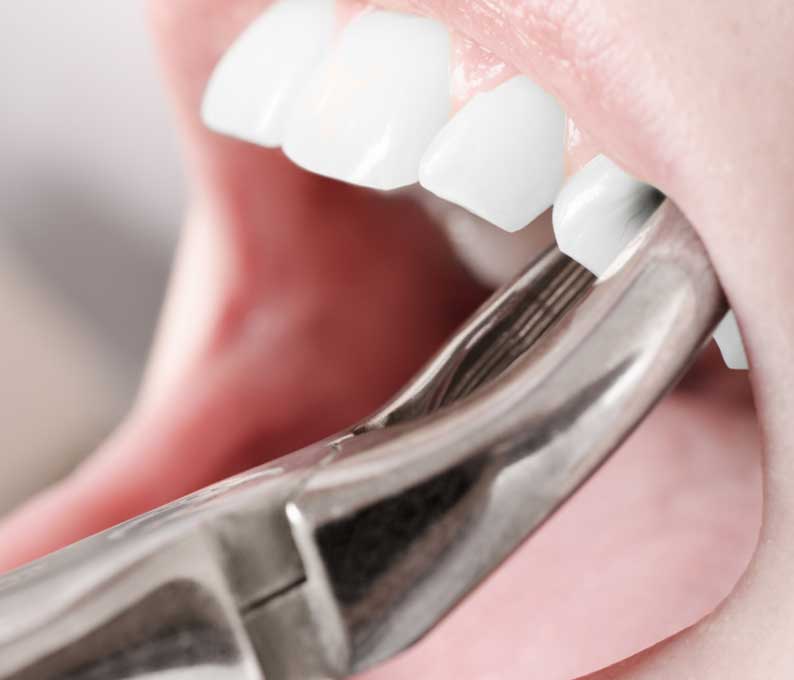 Tooth Extraction