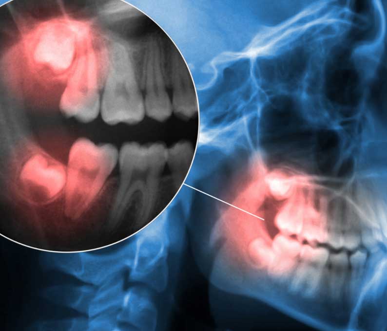 Wisdom Tooth Extraction
