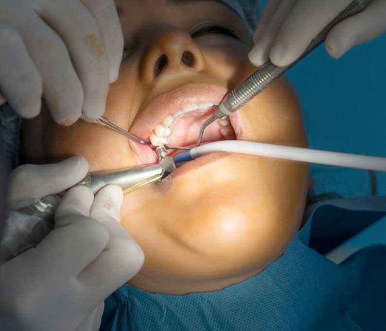 Operculectomy