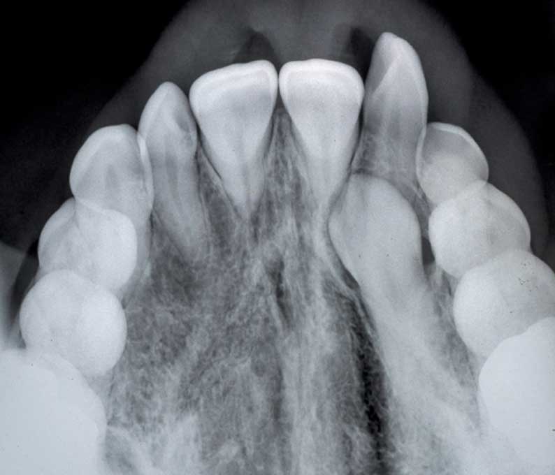 Exposure of Impacted Tooth