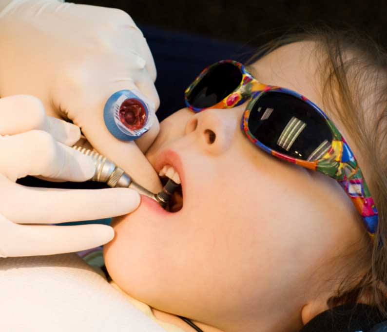 Composite Restoration (Tooth-Colored Fillings)