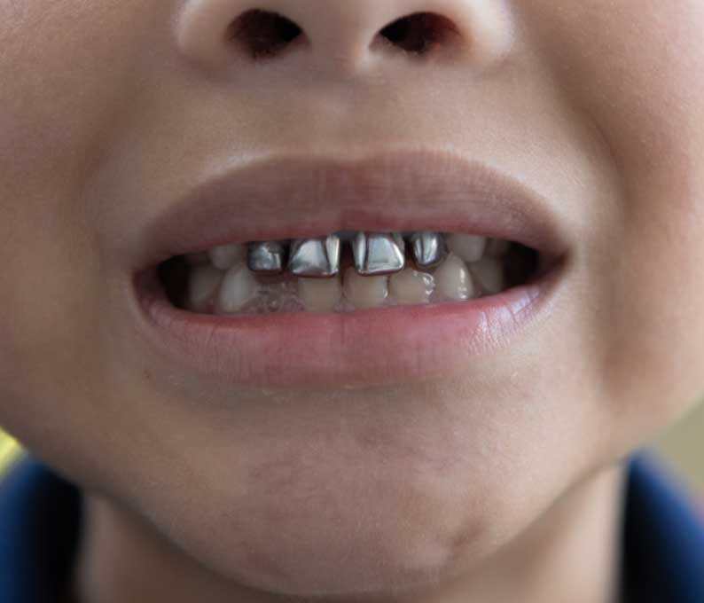 Stainless Steel Crowns