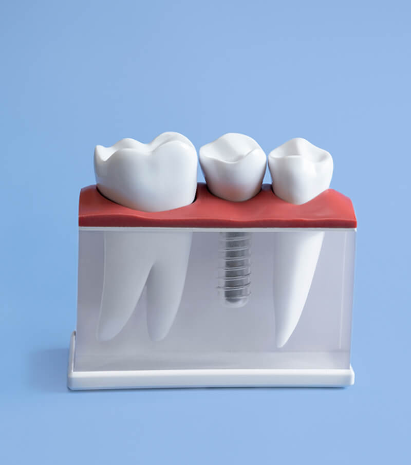 Dental Implants
