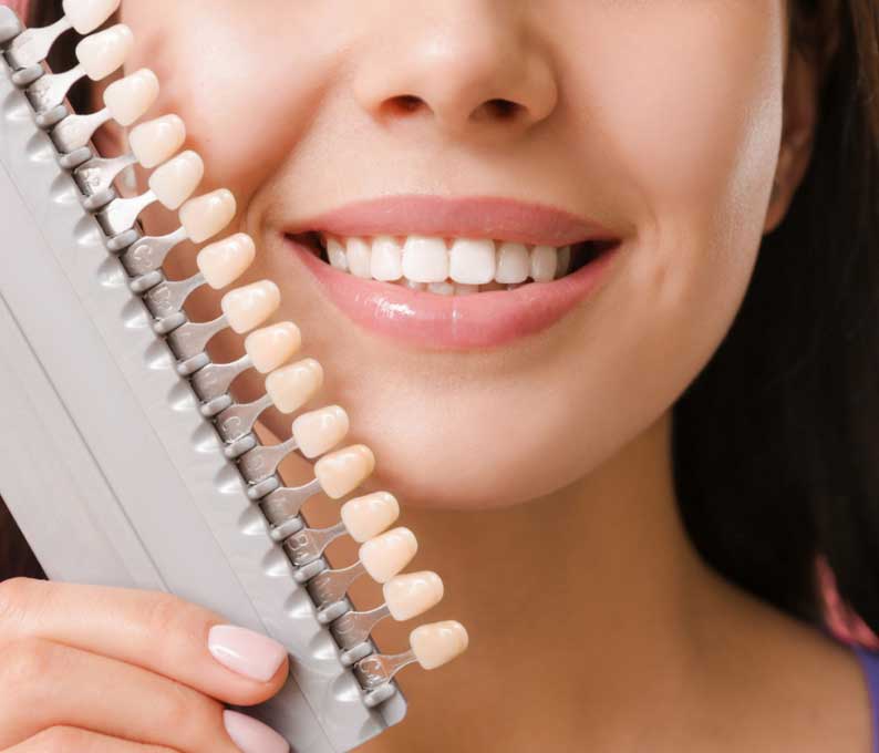 What Are Dental Veneers?