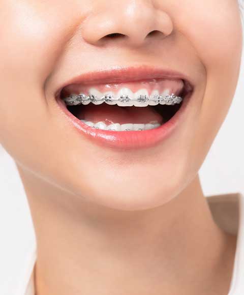 Your Complete Guide to Dental Braces in the Philippines: 2024 Edition